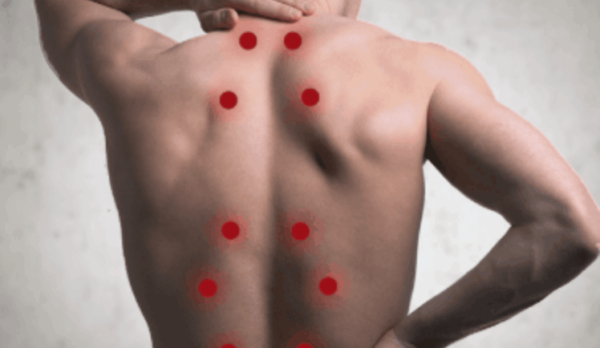 Trigger Point Injections