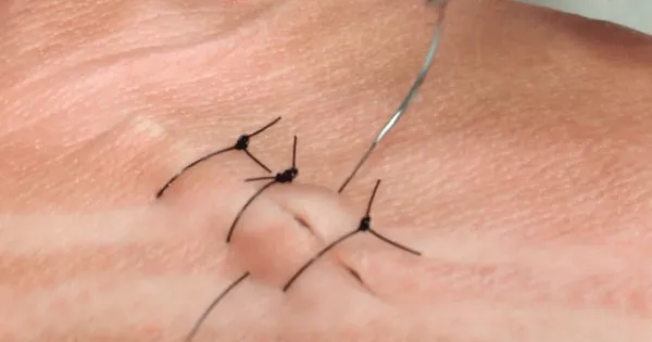 Laceration Repair