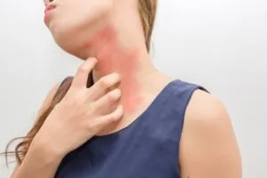 Allergies