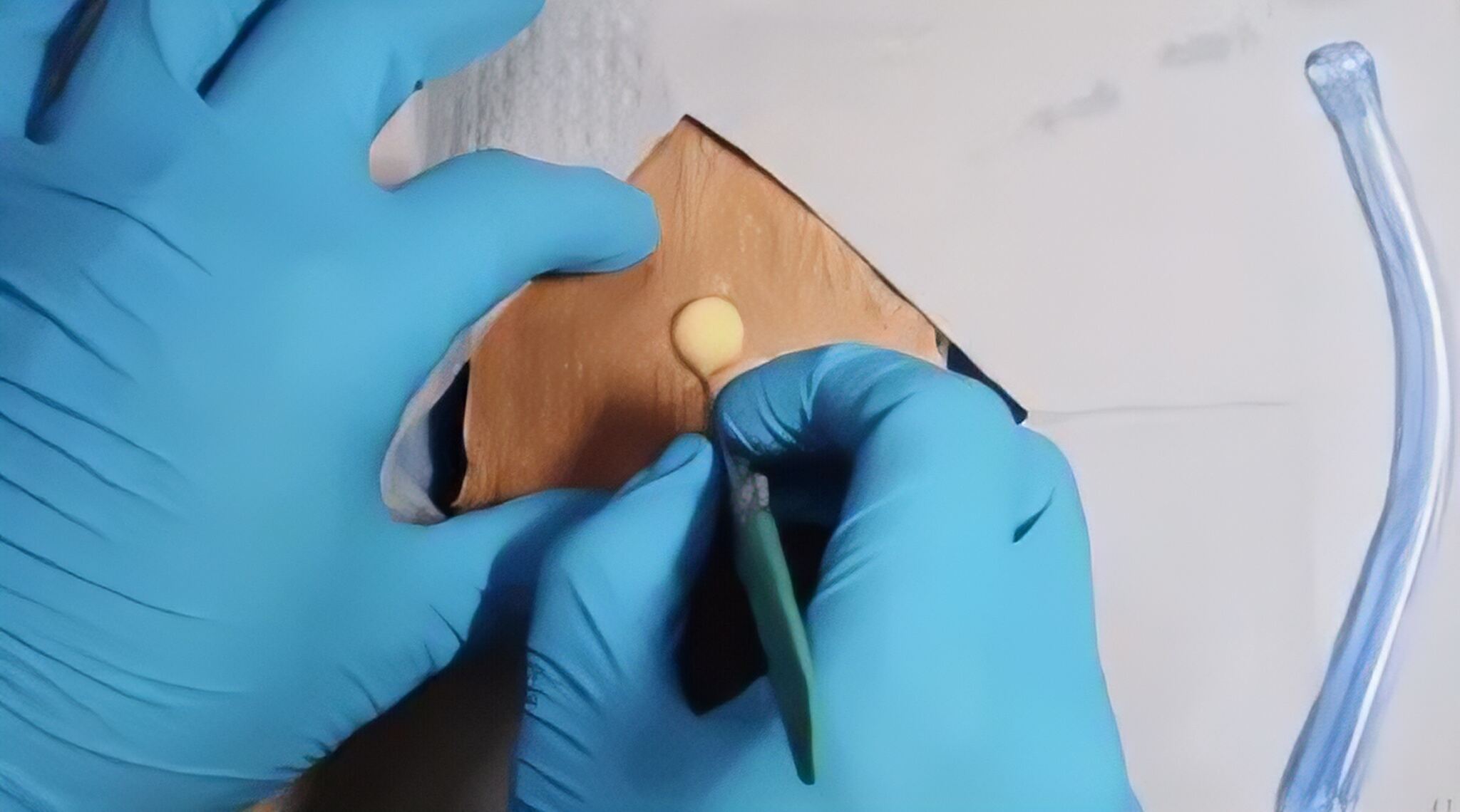 Dr. G Medical Solutions Incision & Drainage Service