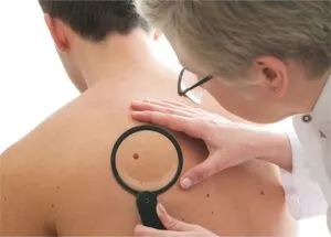 Small Lesion Removal